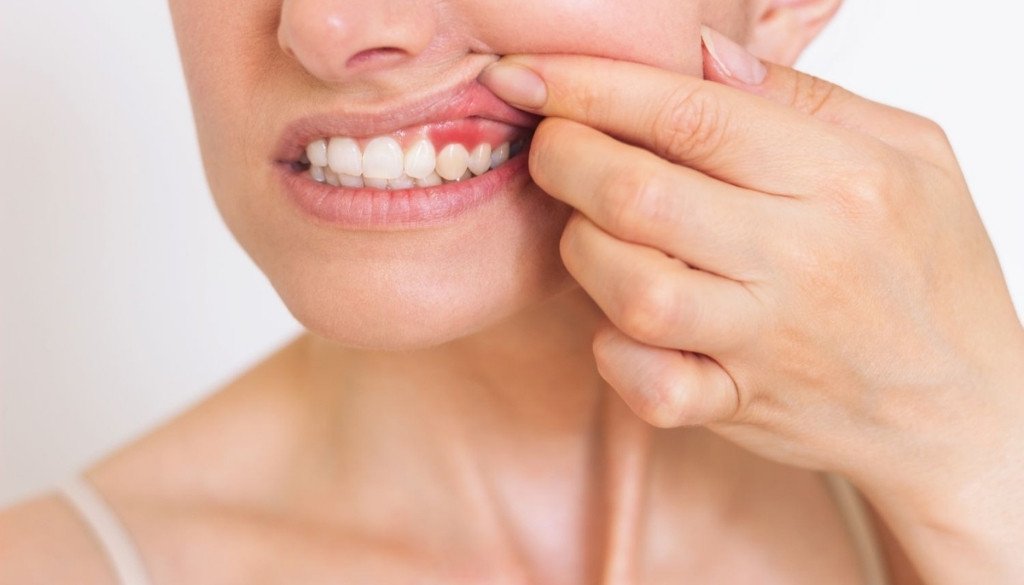 gingivitis treatment in dubai