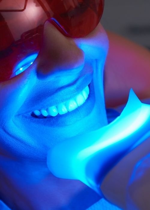 laser teeth whitening