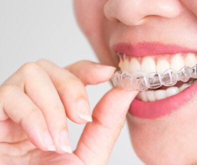 overbite teeth