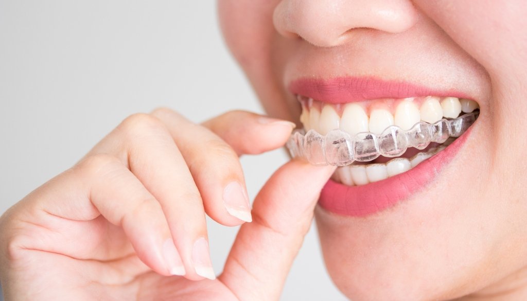 overbite teeth overbite teeth