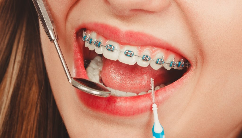 braces dubai