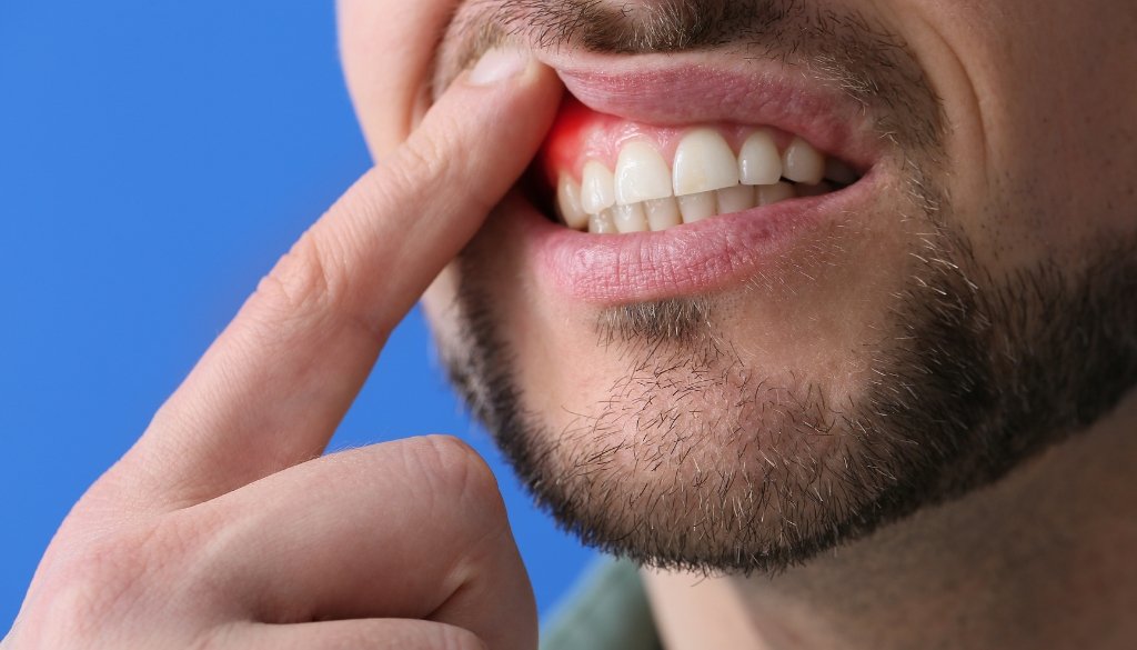 laser periodontal treatment